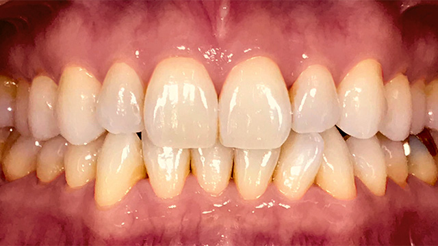 ホワイトニング前