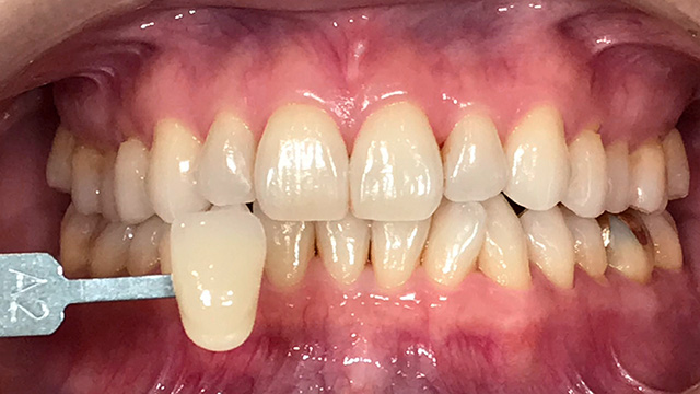 ホワイトニング前