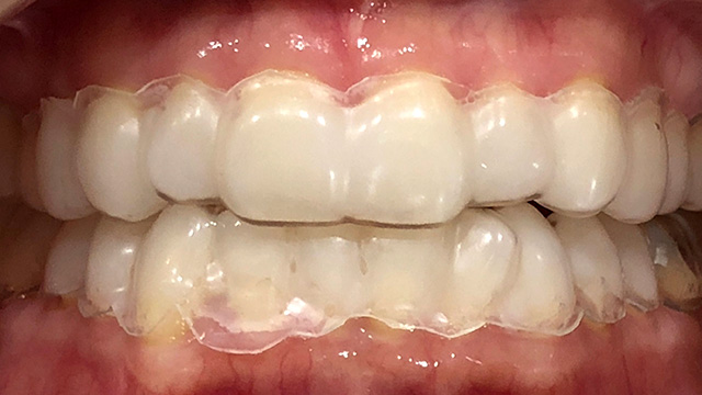 ホワイトニング中