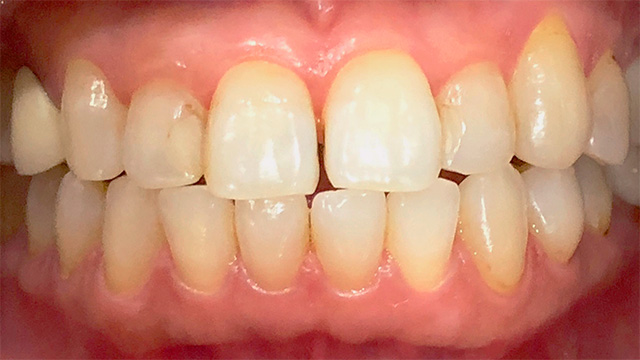 ホワイトニング後