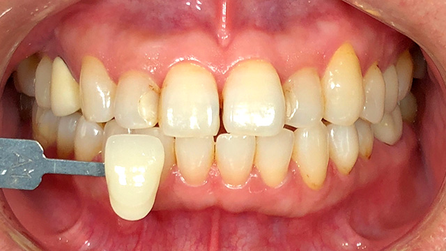 ホワイトニング後