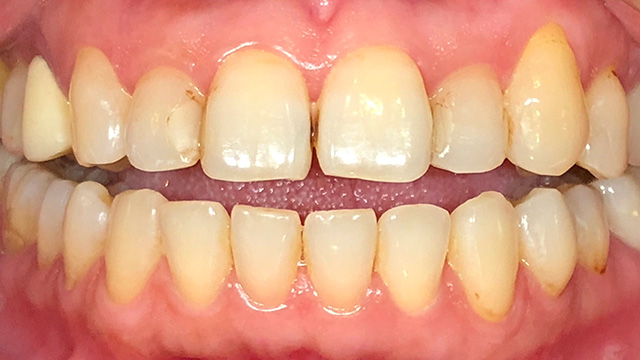 ホワイトニング前