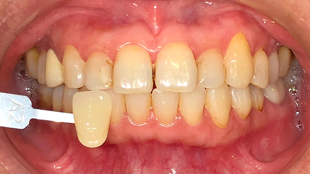 ホワイトニング前