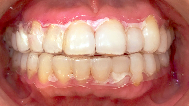 ホワイトニング中