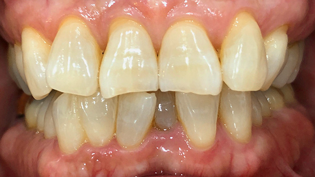 ホームホワイトニング後