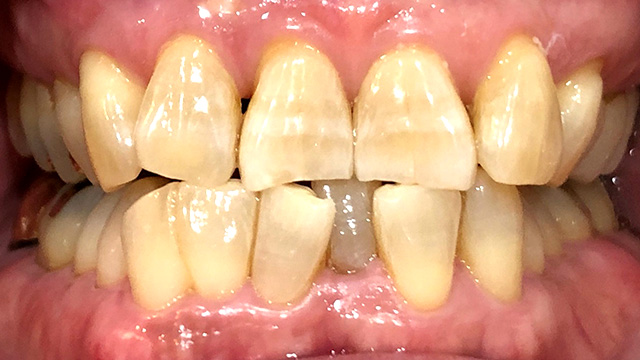 オフィスホワイトニング後