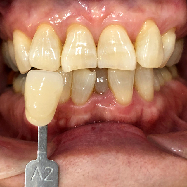 ホワイトニング前