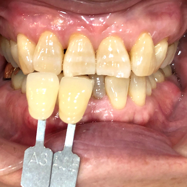 ホワイトニング前