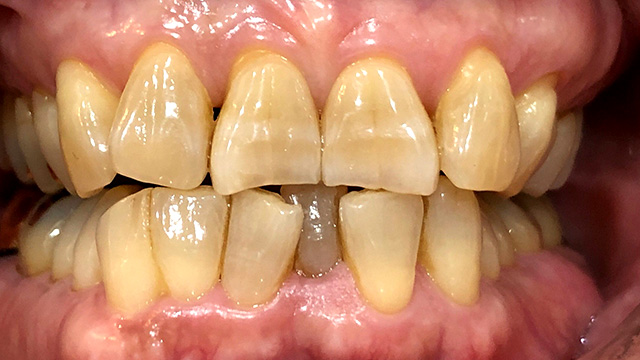 オフィスホワイトニング前