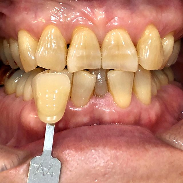 ホワイトニング前