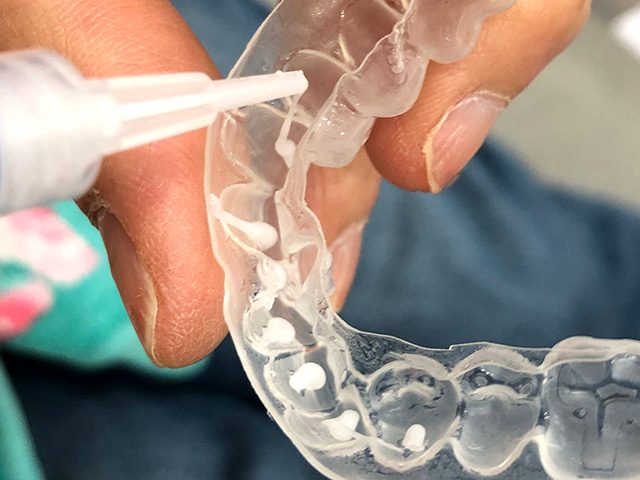 ホームホワイトニング剤　注入の指導