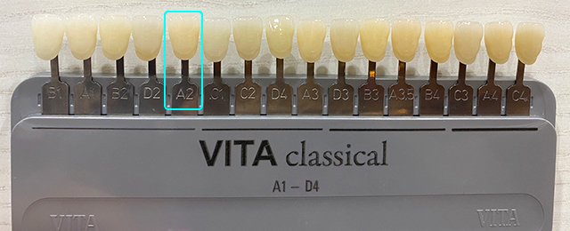 ホワイトニング後