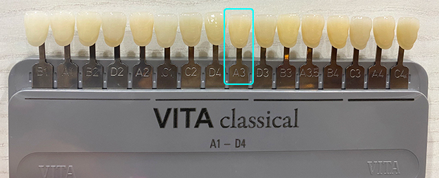 ホワイトニング前