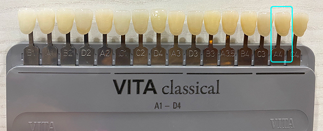 ホワイトニング前