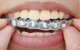 オフィスホワイトニング・ホームホワイトニングの例