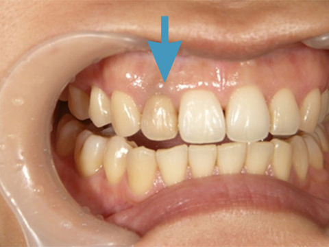 術前（ウォーキングブリーチ前）