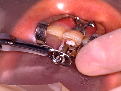 術中（歯の神経が入っていた空洞に薬剤を封入）