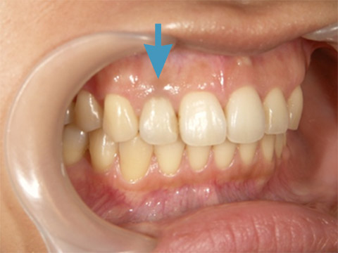 術後（ウォーキングブリーチ後）
