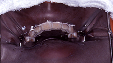 薬剤をしみ込ませたガーゼを歯の表面に置いた状態