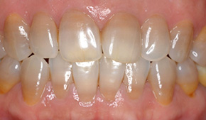 テトラサイクリン変色歯