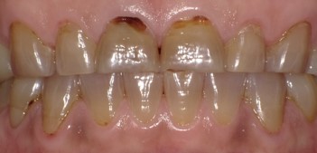 テトラサイクリン変色歯