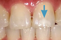 ホワイトスポット