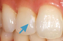 ホワイトスポット