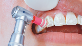 歯のクリーニング