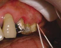 歯周治療における歯科医師と歯科衛生士の新たな役割
