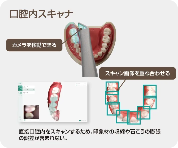 GMDAnote（コラム限定）2025年1月 口腔内スキャナ基礎知識 | 株式会社