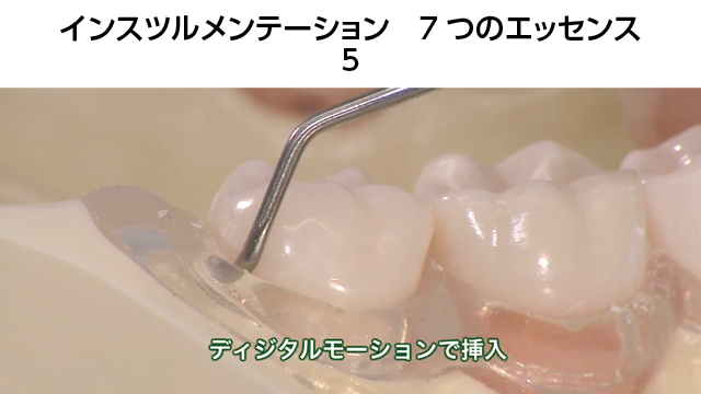 【体験版】インスツルメンテーション 7つのエッセンス　5.SRP～上顎臼歯部～