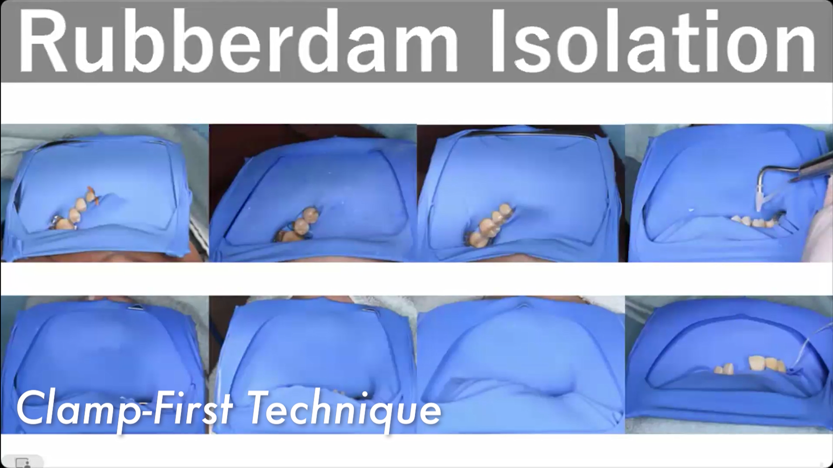 【体験版】Recipe for everX Flow ～接着を添えて～｜ラバーダムテクニック｜クランプファーストテクニック