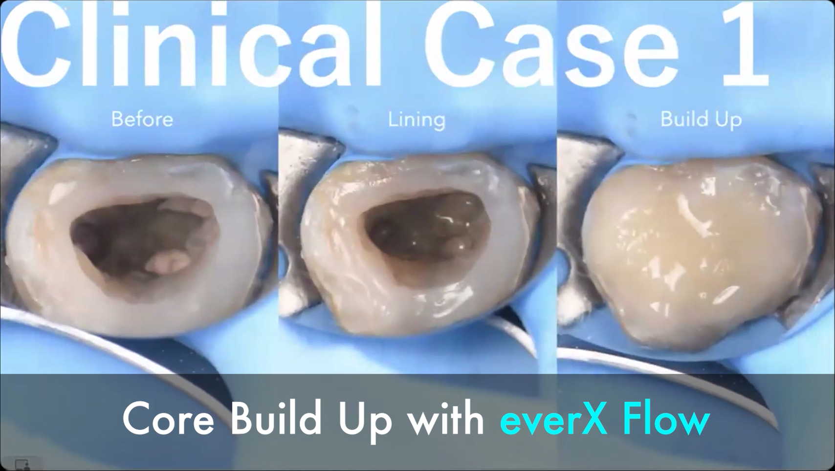 【体験版】Recipe for everX Flow ～接着を添えて～｜保険の支台築造症例｜ライニングの重要性