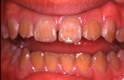 テトラサイクリン系抗菌薬服用による変色歯の例
