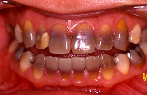 テトラサイクリン系抗菌薬服用による変色歯の例