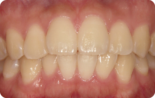 歯と歯茎のイメージ画像