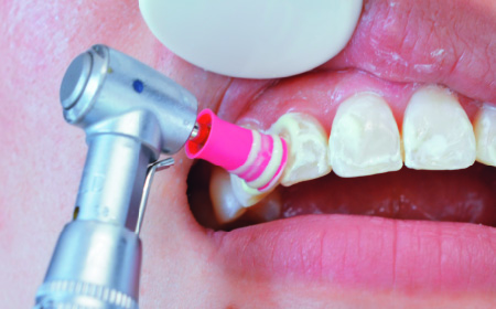 歯のクリーニング