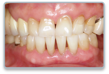 ホワイトニング後の歯のイメージ写真