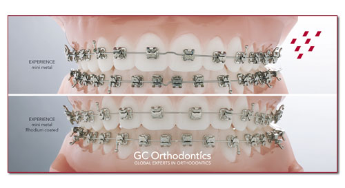 Experience система. Experience Mini Metal GC Orthodontic. Самолигирующие брекеты экспириенс. Experience Metal и Mini Metal брекеты.